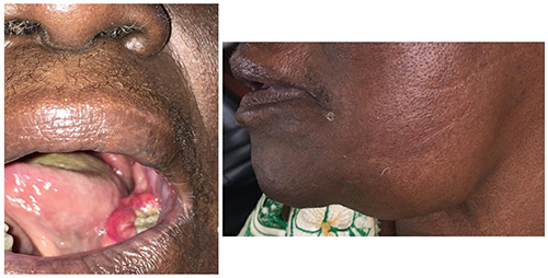 Prevalence, presentation, risk factors and awareness of oral cancer: A  systematic review of the Nigerian experience | Ibom Medical Journal